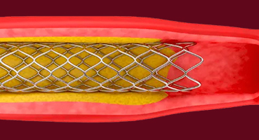 Inspection of stents